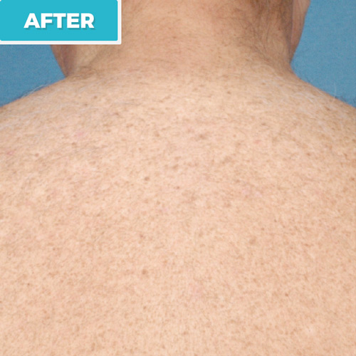 laser hair removal after photo 1